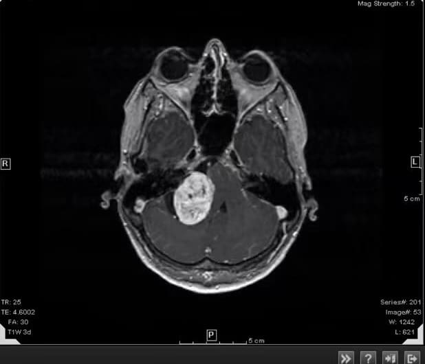Brain MRI scan showing a large bright mass pressed against the brainstem